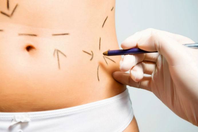 Liposuction