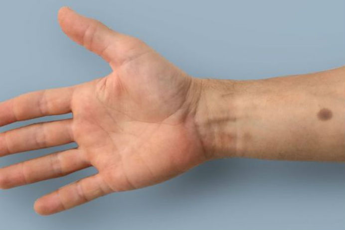 bilim-insanları-kanseri-teşhis-eden-deri-implantı-geliştirdi